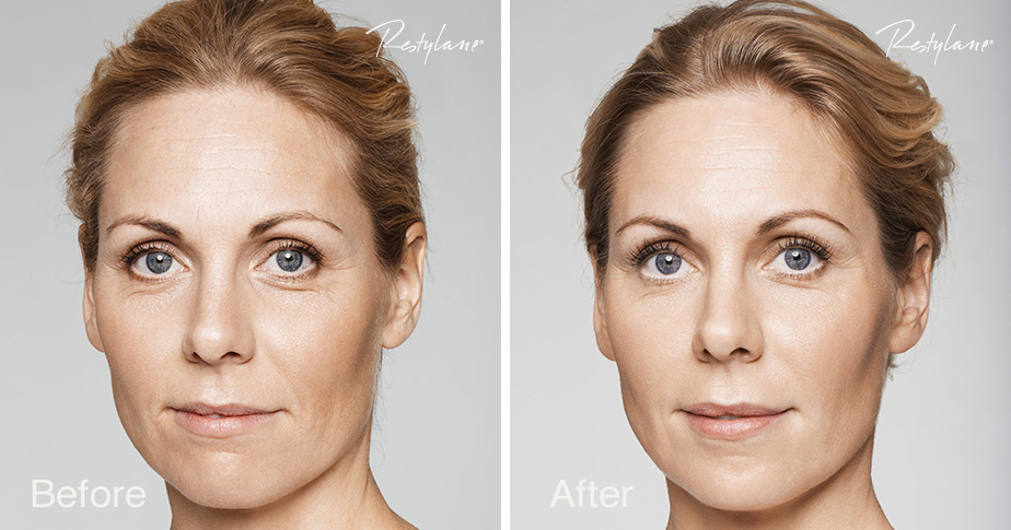 Restylane results