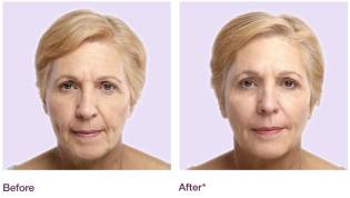 Juvéderm™ results
