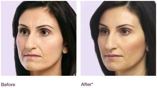 Juvéderm™ results