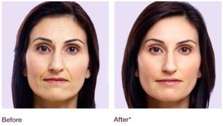 Juvéderm™ results
