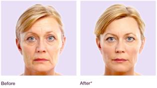 Juvéderm™ results